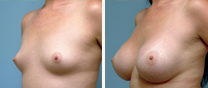 humphreys-breast-augmentation