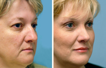 humphreys-rhinoplasty