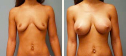 mcdonough-breast-augmentation-2