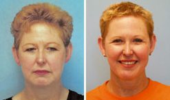 mcdonough-facelift