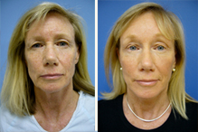 stern-facelift