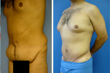 stern-tummy-tuck